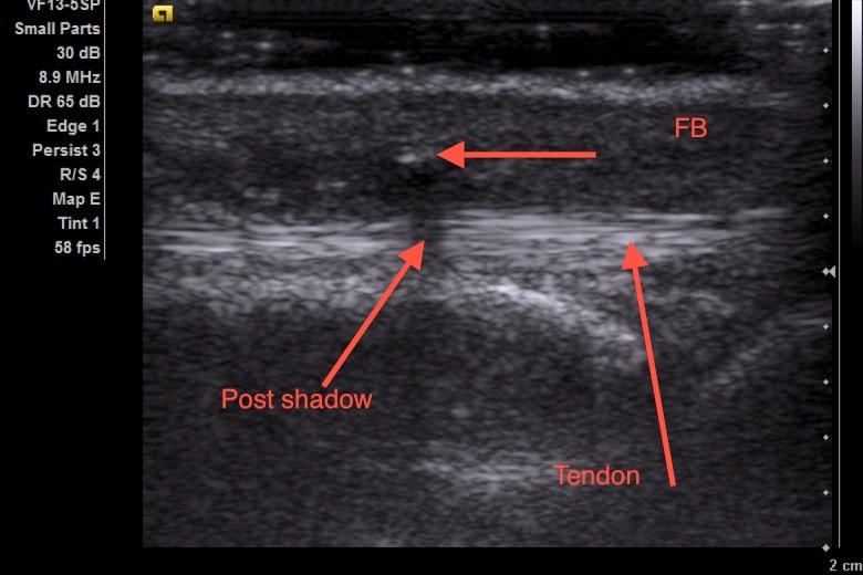 fb tendon