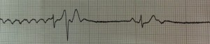resumption of ventricular activity followed by sinus rhythm