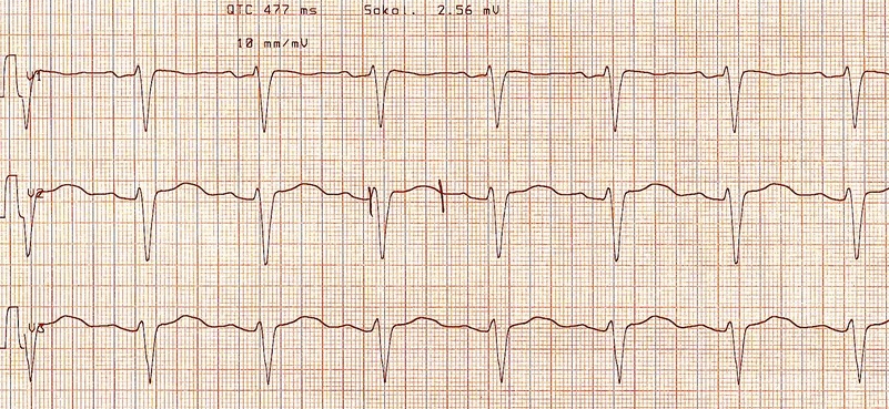 Long QT Featured
