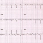 Accelerated Junctional Rhythm Featured