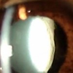 Lens injury Featured