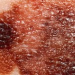 melanoma featured