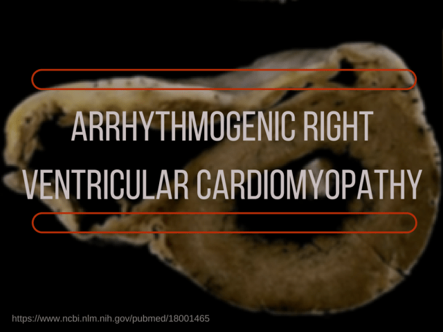 Arrhythmogenic right ventricular cardiomyopathy