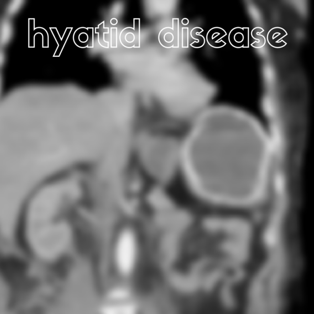 hyatid disease