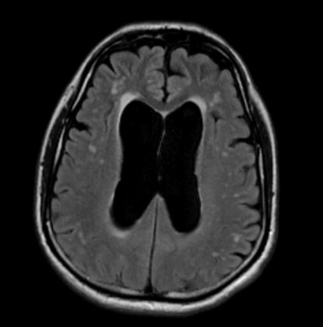 normal-pressure-hydrocephalus-1