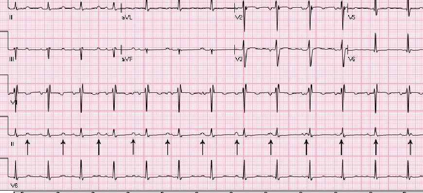 ecg – Emergency Medicine Ireland