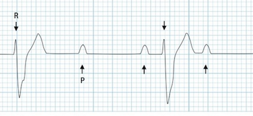 Types Of Heart Block With Ecg Pattern